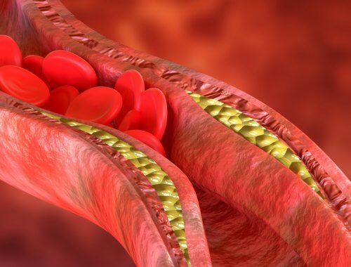 recreación de acumulación de colesterol en las venas