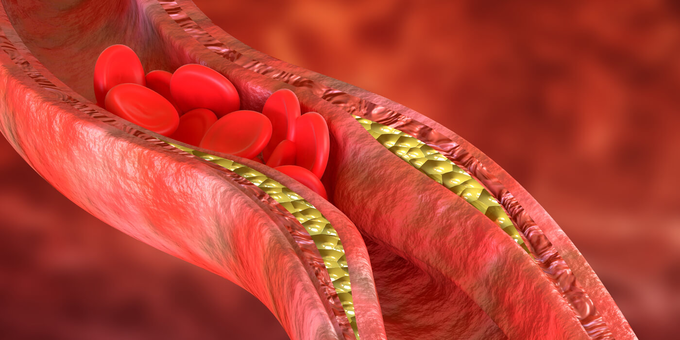 recreación de acumulación de colesterol en las venas